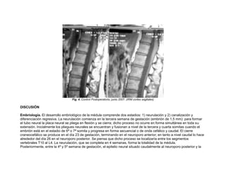 Fig. 4. Control Postoperatorio, junio 2007. (IRM cortes sagitales)

DISCUSIÓN

Embriología. El desarrollo embriológico de la médula comprende dos estadios: 1) neurulación y 2) canalización y
diferenciación regresiva. La neurulación comienza en la tercera semana de gestación (embrión de 1,5 mm): para formar
el tubo neural la placa neural se pliega en flexión y se cierra; dicho proceso no ocurre en forma simultánea en toda su
extensión. Inicialmente los pliegues neurales se encuentran y fusionan a nivel de la tercera y cuarta somitas cuando el
embrión está en el estadio de 6ª o 7ª somita y progresa en forma secuencial o de onda cefálico y caudal. El cierre
craneocefálico se produce en el día 23 de gestación, terminando en el neuroporo anterior; en tanto a nivel caudal lo hace
alrededor del día 26 en el neuroporo posterior. Se piensa que dicho proceso se localizaría entre los segmentos
vertebrales T10 al L4. La neurulación, que se completa en 4 semanas, forma la totalidad de la médula.
Posteriormente, entre la 4º y 5º semana de gestación, el epitelio neural situado caudalmente al neuroporo posterior y la
 