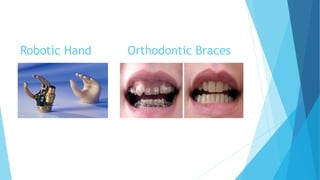 Robotic Hand Orthodontic Braces
 