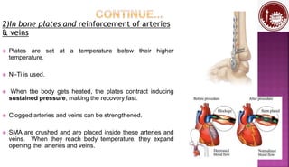 2)In bone plates and reinforcement of arteries
& veins
 Plates are set at a temperature below their higher
temperature.
 Ni-Ti is used.
 When the body gets heated, the plates contract inducing
sustained pressure, making the recovery fast.
 Clogged arteries and veins can be strengthened.
 SMA are crushed and are placed inside these arteries and
veins. When they reach body temperature, they expand
opening the arteries and veins.
 