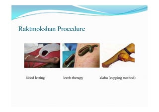 Raktmokshan Procedure
Blood letting leech therapy alabu (cupping method)
 