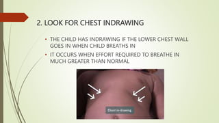 2. LOOK FOR CHEST INDRAWING
• THE CHILD HAS INDRAWING IF THE LOWER CHEST WALL
GOES IN WHEN CHILD BREATHS IN
• IT OCCURS WHEN EFFORT REQUIRED TO BREATHE IN
MUCH GREATER THAN NORMAL
 