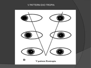 V PATTERN EXO TROPIA
 