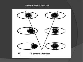 V PATTERN ESOTROPIA
 
