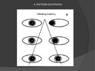 A -PATTERN EXOTROPIA
 