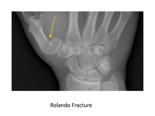 Hand fractures ppt by Dr Ahsan | PPTX