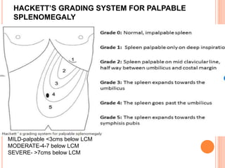HACKETT’S GRADING SYSTEM FOR PALPABLE
SPLENOMEGALY
MILD-palpable <3cms below LCM
MODERATE-4-7 below LCM
SEVERE- >7cms below LCM
 