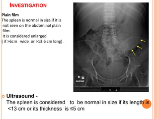 INVESTIGATION
 Ultrasound -
The spleen is considered to be normal in size if its length is
<13 cm or its thickness is ≤5 cm
Plain film
The spleen is normal in size if it is
not seen on the abdominal plain
film.
It is considered enlarged
( if >6cm wide or >13.6 cm long) .
 