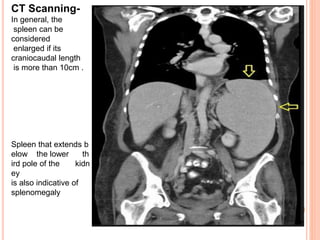 CT Scanning-
In general, the
spleen can be
considered
enlarged if its
craniocaudal length
is more than 10cm .
Spleen that extends b
elow the lower th
ird pole of the kidn
ey
is also indicative of
splenomegaly
 