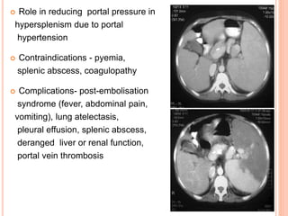 Role in reducing portal pressure in
hypersplenism due to portal
hypertension
 Contraindications - pyemia,
splenic abscess, coagulopathy
 Complications- post-embolisation
syndrome (fever, abdominal pain,
vomiting), lung atelectasis,
pleural effusion, splenic abscess,
deranged liver or renal function,
portal vein thrombosis
 