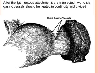 After the ligamentous attachments are transected, two to six
gastric vessels should be ligated in continuity and divided
 