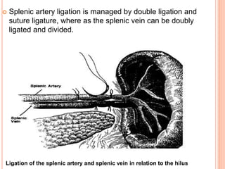  Splenic artery ligation is managed by double ligation and
suture ligature, where as the splenic vein can be doubly
ligated and divided.
Ligation of the splenic artery and splenic vein in relation to the hilus
 