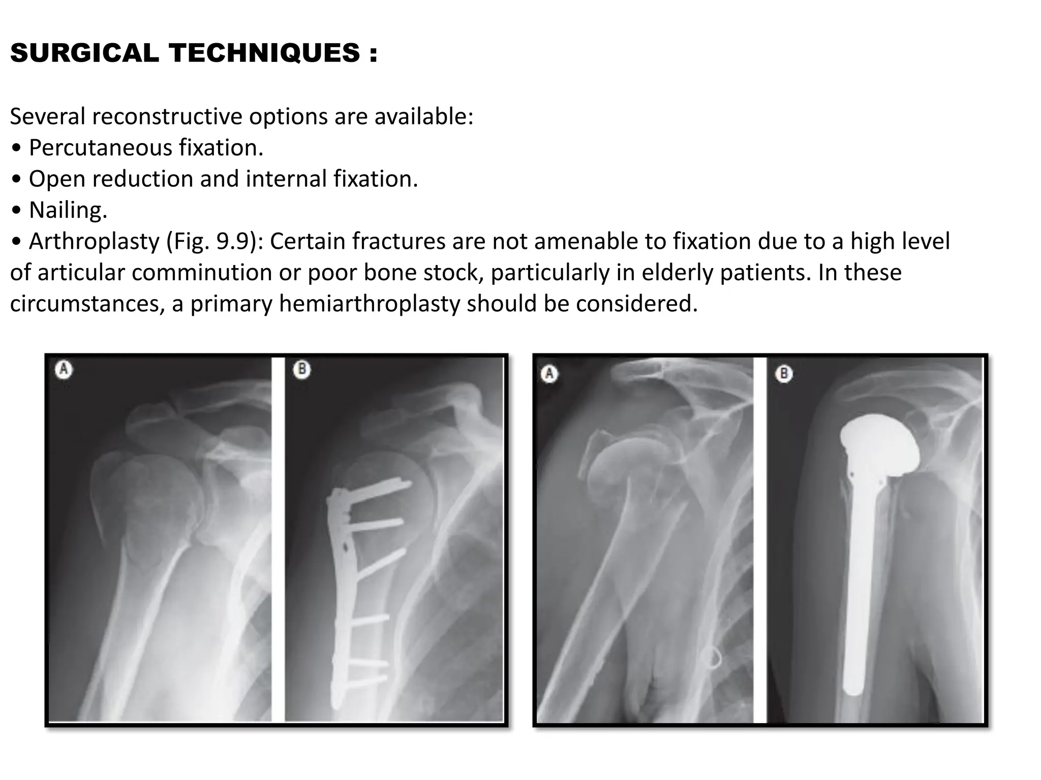 SURGICAL TECHNIQUES :
Several reconstructive options are available:
• Percutaneous fixation.
• Open reduction and internal fixation.
• Nailing.
• Arthroplasty (Fig. 9.9): Certain fractures are not amenable to fixation due to a high level
of articular comminution or poor bone stock, particularly in elderly patients. In these
circumstances, a primary hemiarthroplasty should be considered.
 