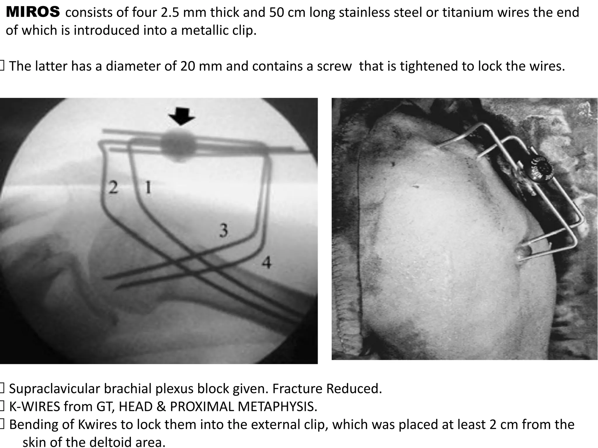 MIROS consists of four 2.5 mm thick and 50 cm long stainless steel or titanium wires the end
of which is introduced into a metallic clip.
The latter has a diameter of 20 mm and contains a screw that is tightened to lock the wires.
Supraclavicular brachial plexus block given. Fracture Reduced.
K-WIRES from GT, HEAD & PROXIMAL METAPHYSIS.
Bending of Kwires to lock them into the external clip, which was placed at least 2 cm from the
skin of the deltoid area.
 