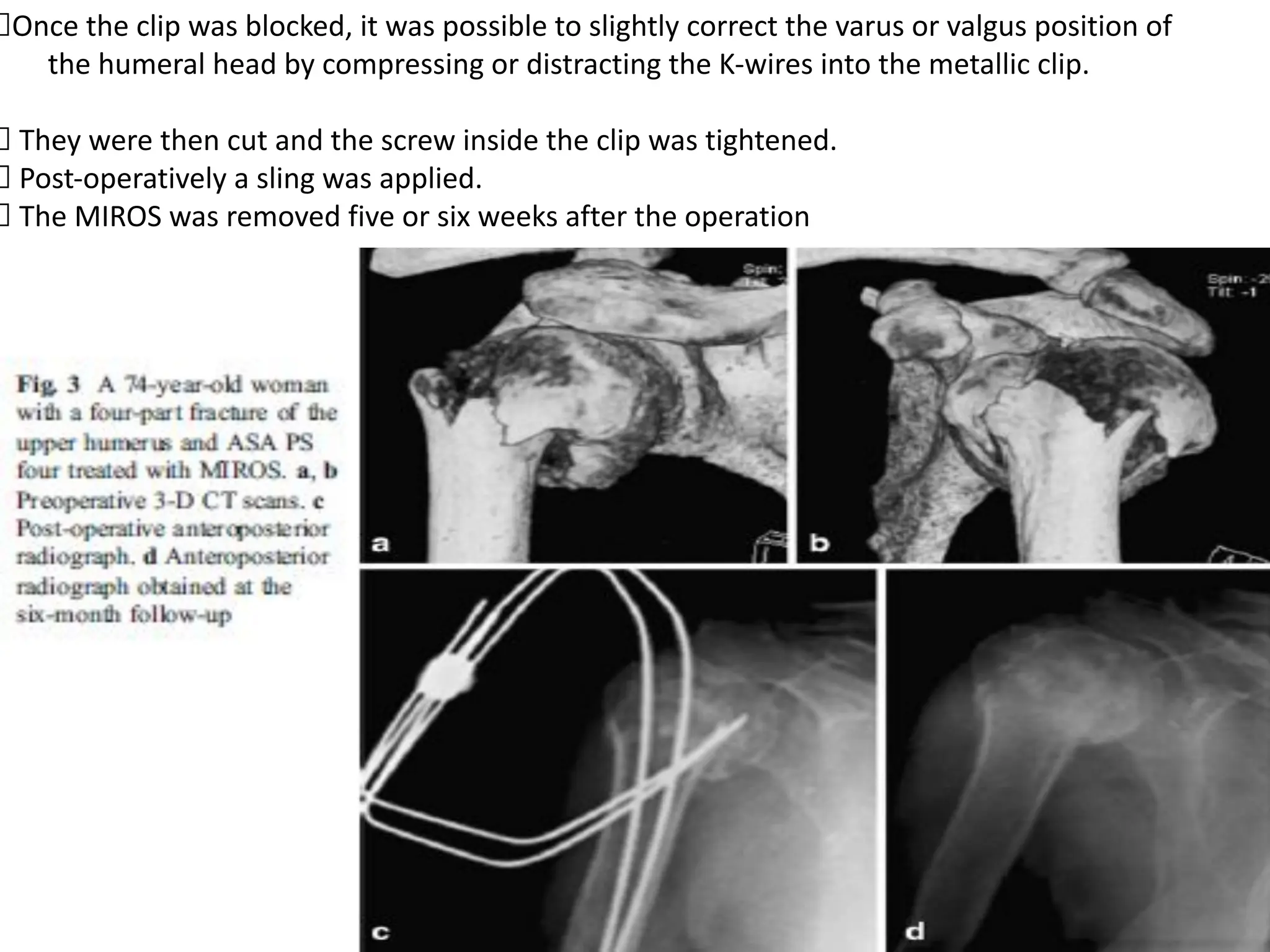 Once the clip was blocked, it was possible to slightly correct the varus or valgus position of
the humeral head by compressing or distracting the K-wires into the metallic clip.
They were then cut and the screw inside the clip was tightened.
Post-operatively a sling was applied.
The MIROS was removed five or six weeks after the operation
 