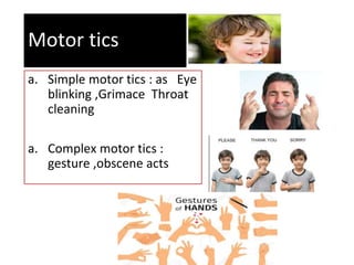 Motor tics
a. Simple motor tics : as Eye
blinking ,Grimace Throat
cleaning
a. Complex motor tics :
gesture ,obscene acts
 