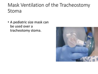 Mask Ventilation of the Tracheostomy
Stoma
• A pediatric size mask can
be used over a
tracheotomy stoma.
 