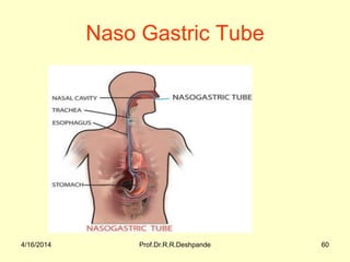 4/16/2014 Prof.Dr.R.R.Deshpande 60
Naso Gastric Tube
 