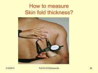 4/16/2014 Prof.Dr.R.R.Deshpande 86
How to measure
Skin fold thickness?
 
