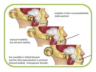 occlusal instability
but still joint stability
the mandible is shifted forward
and the intercuspal position is achieved
Occlusal loading - intracapsular disorder.
condyles in their musculoskeletally
stable position
 