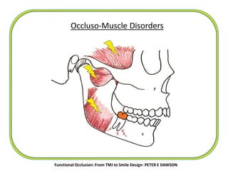 Occluso-Muscle Disorders
Functional Occlusion: From TMJ to Smile Design- PETER E DAWSON
 