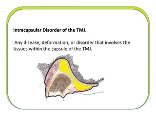 Intracapsular Disorder of the TMJ.
Any disease, deformation, or disorder that involves the
tissues within the capsule of the TMJ.
 