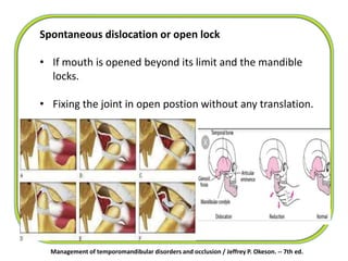 Spontaneous dislocation or open lock
• If mouth is opened beyond its limit and the mandible
locks.
• Fixing the joint in open postion without any translation.
Management of temporomandibular disorders and occlusion / Jeffrey P. Okeson. -- 7th ed.
 