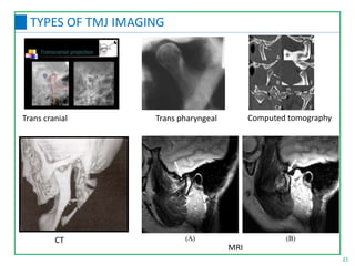 MRI
Trans cranial Trans pharyngeal Computed tomography
21
TYPES OF TMJ IMAGING
CT
 
