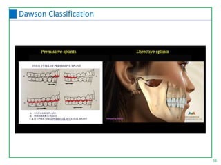 56
Dawson Classification
 