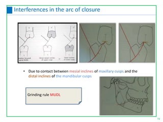 • Due to contact between mesial inclines of maxillary cusps and the
distal inclines of the mandibular cusps
Grinding rule MUDL
72
Interferences in the arc of closure
 