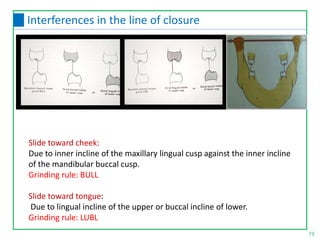 Slide toward cheek:
Due to inner incline of the maxillary lingual cusp against the inner incline
of the mandibular buccal cusp.
Grinding rule: BULL
Slide toward tongue:
Due to lingual incline of the upper or buccal incline of lower.
Grinding rule: LUBL
73
Interferences in the line of closure
 