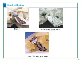 87
LiteratureReview
Biomet Christensen prosthesis
TMJ concepts prosthesis
 