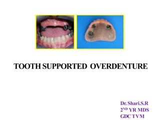 TOOTHSUPPORTED OVERDENTURE
Dr.Shari.S.R
2ND YR MDS
GDCTVM
 