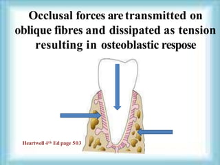 Occlusal forces aretransmitted on
oblique fibres and dissipated as tension
resulting in osteoblastic respose
Heartwell 4th Ed page 503
 
