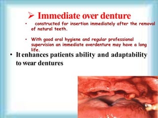  Immediate over denture
• Itenhances patients ability and adaptability
to wear dentures
• constructed for insertion immediately after the removal
of natural teeth.
• With good oral hygiene and regular professional
supervision an immediate overdenture may have a long
life.
.
 