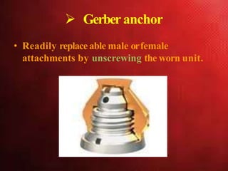  Gerberanchor
• Readily replaceable male orfemale
attachments by unscrewing the worn unit.
 