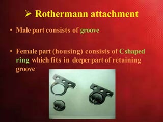 Rothermann attachment
• Male part consists of groove
• Female part (housing) consists of Cshaped
ring which fits in deeperpart of retaining
groove
 