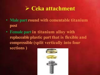  Ceka attachment
• Male part round with cementable titanium
post
• Female part in titanium alloy with
replaceableplastic part that is flexible and
compressible (split vertically into four
sections )
 