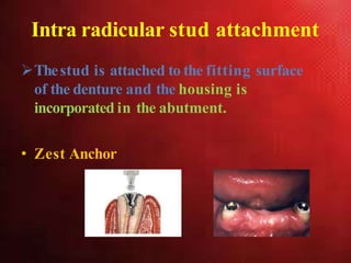 Intra radicular stud attachment
Thestud is attached to the fitting surface
of the denture and the housing is
incorporated in the abutment.
• Zest Anchor
 