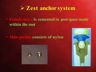  Zest anchorsystem
• Female sleeve is cemented in post space made
within the root
• Male portion consists of nylon
 