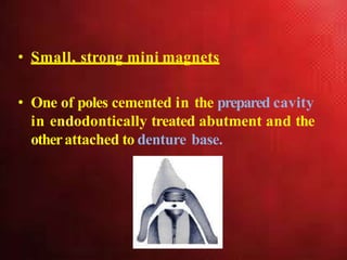 • Small, strong mini magnets
• One of poles cemented in the prepared cavity
in endodontically treated abutment and the
otherattached to denture base.
 