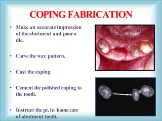 COPING FABRICATION
• Make an accurate impression
of the abutment and poura
die.
• Carvethe wax pattern.
• Cast the coping
• Cement the polished coping to
the tooth.
• Instruct the pt. in home care
of abutment tooth.
 