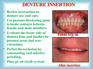 DENTURE INSERTION
• Review instruction in
denture use and care.
• Use pressure disclosing paste
to locate contacts between
female and male members.
• Evaluate the tissue side of
denture base and bordersfor
pressure areas and over
extensions.
• Perfect the occlusion by
remounting and selective
grinding.
• Place pt. on recall system
After insertion
Final try in
 