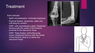 Treatment
Extra articular:
Splint immobilisation- minimally displaced
External fixation- temporary, collar and
cuff sling for comfort
ORIF- with neutralisation plate- Displaced
fracture with the center of the fracture
proximal to the olecranon fossa
ORIF- Plate fixation with/without lag
screw- Displaced fracture with the center
of the fracture close to or below the
olecranon fossa
 