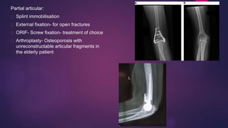 Partial articular:
Splint immobilisation
External fixation- for open fractures
ORIF- Screw fixation- treatment of choice
Arthroplasty- Osteoporosis with
unreconstructable articular fragments in
the elderly patient
 