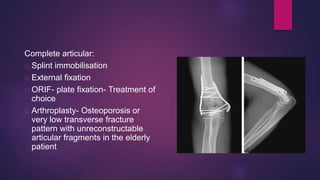 Complete articular:
Splint immobilisation
External fixation
ORIF- plate fixation- Treatment of
choice
Arthroplasty- Osteoporosis or
very low transverse fracture
pattern with unreconstructable
articular fragments in the elderly
patient
 