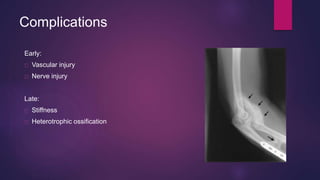 Complications
Early:
Vascular injury
Nerve injury
Late:
Stiffness
Heterotrophic ossification
 