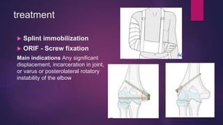 treatment
 Splint immobilization
 ORIF - Screw fixation
Main indications Any significant
displacement, incarceration in joint,
or varus or posterolateral rotatory
instability of the elbow
 
