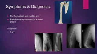 Symptoms & Diagnosis
 Painful, bruised and swollen arm
 Radial nerve injury common at lower
groove
Diagnosis:
X-ray
 