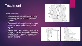 Treatment
Non operative:
Indications- Closed isolated injury,
minimally displaced, cooperative
patient
Contraindication- polytrauma, open
fracture, nerve interposed, nerve
injury
Reduction, cast padding, splint (U-
shape), braces (simple molded cuff),
mobilization ( pendulum exercise,
elbow flexion)
 