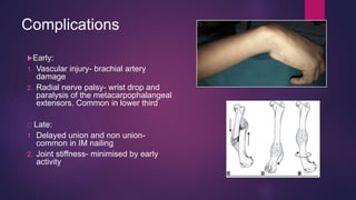 Complications
Early:
1. Vascular injury- brachial artery
damage
2. Radial nerve palsy- wrist drop and
paralysis of the metacarpophalangeal
extensors. Common in lower third
Late:
1. Delayed union and non union-
common in IM nailing
2. Joint stiffness- minimised by early
activity
 
